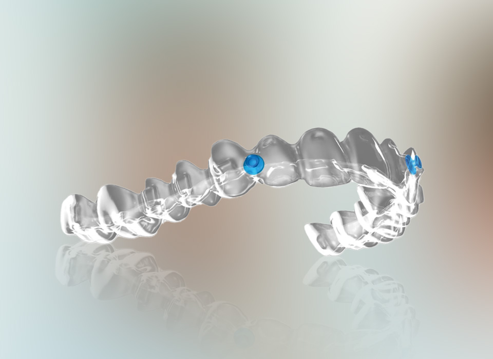 Angel Aligners